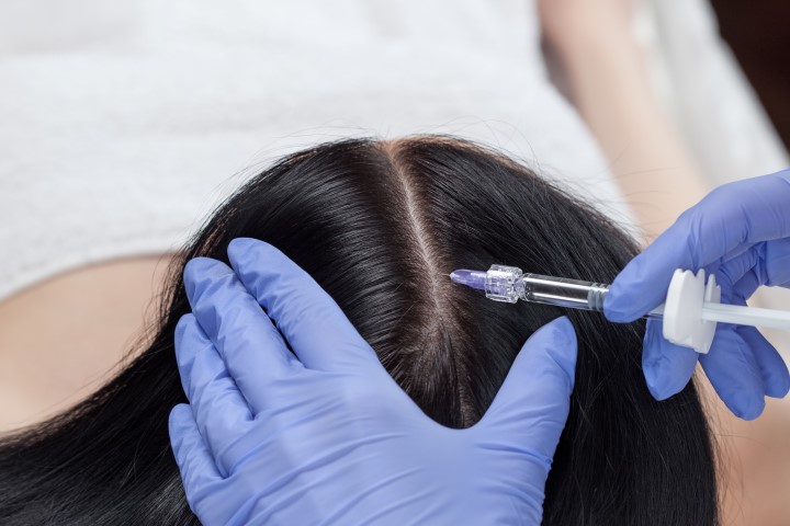 مزوتراپی مو چیست